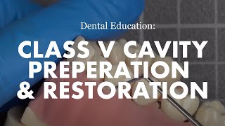 Class V cavity preparation and restoration [upl. by Cruickshank]