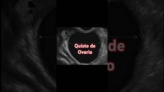 Quiste de ovario [upl. by Mingche]