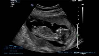 Scan of the Week 15 Weeks Pregnant The Advanced Early Ultrasound [upl. by Elik752]