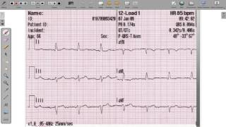 ECG 12 Lead Axis Deviation [upl. by Sheena]