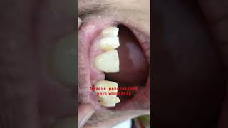 Severe generalized periodontitis causing spacing in teeth dentaltreatmentviral videoperiodontitis [upl. by Kyre]