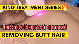 Butt Laser Hair Removal The Ultimate HairFree Solution Exposed [upl. by Aicsile]