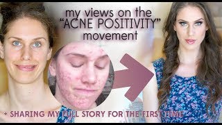 What I Really Think Of quotACNE POSITIVITYquot Sharing My Full Emotional Acne Story GRWM Acne Awareness [upl. by Arihsat]