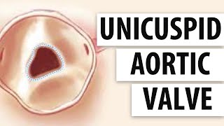 Unicuspid Aortic Valves Top 5 Facts Patients Should Know [upl. by Theron636]