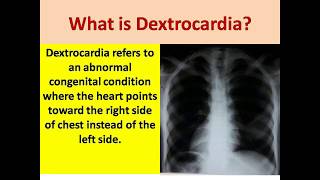 What is Dextrocardia  Dextrocadia Facts [upl. by Biggs]