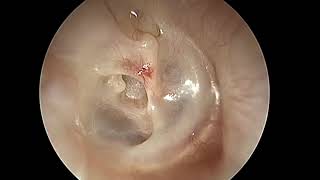 Endoscopic tympanoplasty with ossiculoplasty [upl. by Hayidan605]