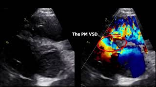 Double chamber right ventricle echocardiography DCRV [upl. by Meela444]