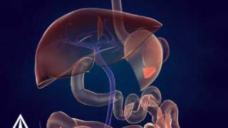 Whipple Procedure  3D Medical Animation [upl. by Peck883]