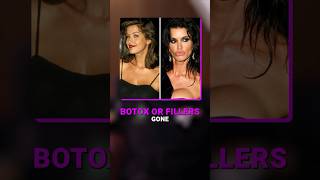 Dr Praharsh Devraj explains fillers and botox gone wrong bangalore fillers botox botoxfillers [upl. by Clevey184]