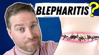 What Is Blepharitis Blepharitis Explained  Best Treatments [upl. by April]