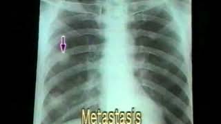 31 Bronchogenic Carcinoma  Chest XRays  Dr Vaidya [upl. by Ytirahc]