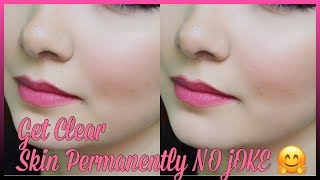 100 Acne Proof face by using only one product [upl. by Nifled]