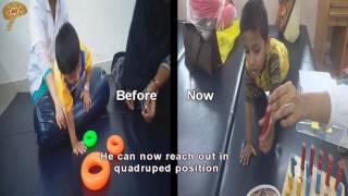 Cerebral Palsy New Treatment Results Quick Look No 3111 [upl. by Clova]