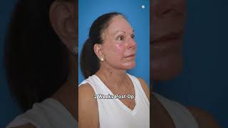 Stunning 6Month Preservation Facelift Transformation [upl. by Nelrac]