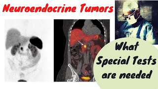 Neuroendocrine Tumors Why special tests are required [upl. by Nordin759]