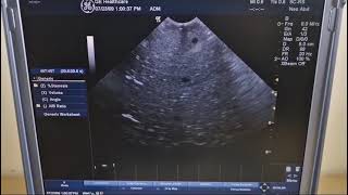 portable ultrasound logiq e GE with Curved Array transducer GE 8CRS probe [upl. by Alrahs245]