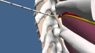 Techniques for Thoracic Paravertebral Block TPVB [upl. by Obaza]