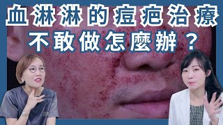 不敢做血淋淋的痘疤治療？除了UP雷射，這些痘疤治療方法也很見效！ [upl. by Wavell]