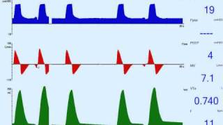 Patient Ventilator Asynchrony Trigger Delay [upl. by Cochran]