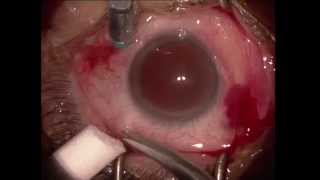 Vitrectomie pelage pour membrane epimaculaire  Vitrectomy for epiretinal membrane [upl. by Ennasirk682]