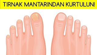 TIRNAK MANTARINDAN KURTULMANIN 5 DOĞAL YÖNTEMİ [upl. by Mireielle725]