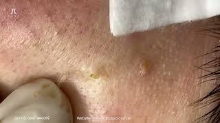 Big Cystic Acne Blackheads Extraction Blackheads amp Milia Whiteheads Removal Pimple Popping [upl. by Hewes]