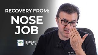 How Long Does Recovery Take For A Nose Job  Rhinoplasty Surgery Recovery Guide [upl. by Billy]