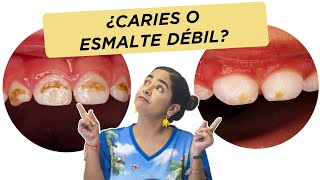 ¿Es caries o esmalte débil [upl. by Latham]