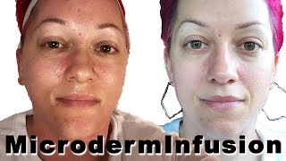 Microderm Infusion Facial  Informative Video [upl. by Flyn16]