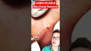 Stunning LIP BLACKHEAD REMOVAL  Biggest Blackheads Ever shorts [upl. by Wylen]