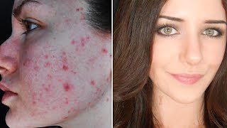 How To Cover Acne amp Scars IF You Want To  Easy Makeup Transformation Routine [upl. by Lyndsay513]