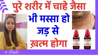 मस्से का इलाज  मस्से को जड़ से हटाने के उपाय  masse hatane ki homeopathic medicine  warts ka ilaj [upl. by Othilie963]