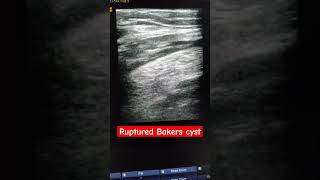 Ruptured bakers cyst with leakage of fluid btw fascia plane of semimembranosus and gastrocnemius [upl. by Kaela58]