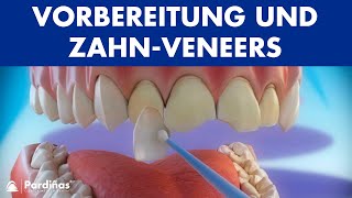 Veneers – Vorbereitung und ZahnVeneers Stellung © [upl. by Chaffinch]