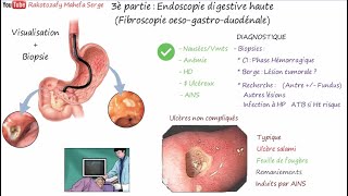 ULCÈRES GASTRIQUE ET DUODÉNAL  3è Partie  Endoscopie digestive haute FOGD [upl. by Nosde]