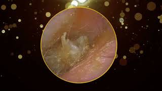 Whats Hiding in Your Ear Canal Debridement Reveals All [upl. by Zed444]