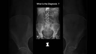 Small bowel obstruction  Abdominal Xray Abnormalities Normal reference 65 radiologychannel007 [upl. by Amelie]