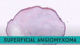 Superficial angiomyxoma cutaneous myxoma pathology dermpath dermatology dermatopathology [upl. by Algie]