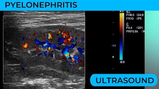 Pylenonephritis on ultrasound what to look for [upl. by Anifad]