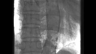 Dense Calcification in the Aorta [upl. by Naot647]