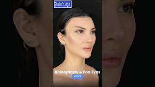 Fox Eye Surgery Before and After  Fox Eye Lift Surgery  Rhinoplasty Experience Before and After [upl. by Leidag295]