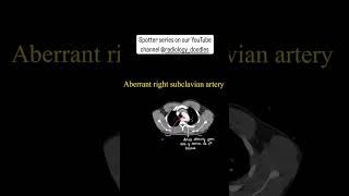 Aberrant right subclavian artery radiology anatomy xray mri ctscan chest hrct [upl. by Colvin]