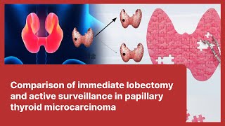 15 Comparison of immediate lobectomy and active surveillance in papillary thyroid microcarcinoma [upl. by Htebzil295]