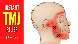 How to Relieve TMJ Pain at Home  30 SECOND RELIEF [upl. by Andris]