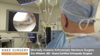 Arthroscopic Knee Surgery  Meniscus Surgery Performed by Dr Millstein [upl. by Narda]