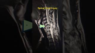 Spinal Cord Injury [upl. by Columbine]