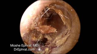 Ear Wax Removal [upl. by Amena]