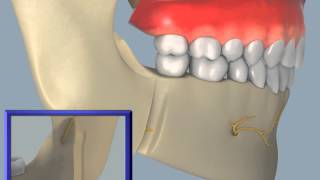 Sagittal Split Osteotomy [upl. by Nosyd]