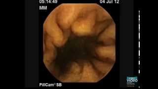 The PillCam Detection of Meckels Diverticulum [upl. by Salim854]