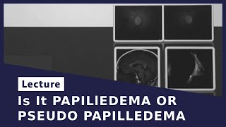 Is It PAPILlEDEMA OR PSEUDO PAPILLEDEMA [upl. by Lielos]